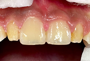 Norwalk Dental Center | Pediatric Dentistry, Oral Cancer Screening and Dental Bridges