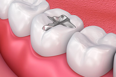 Norwalk Dental Center | Oral Cancer Screening, Preventative Program and Dental Fillings