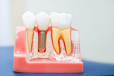 Norwalk Dental Center | Dental Bridges, Dental Cleanings and Digital Radiography